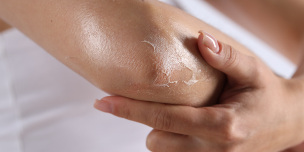 Peau sèche : 5 astuces indispensables pour retrouver du confort